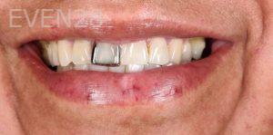 Ahmad-Aghakhan-Moheb-Dr-Sasha-Dental-Crowns-before-4