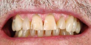 Ahmad-Aghakhan-Moheb-Dr-Sasha-Dental-Crowns-before-5
