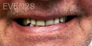 Ahmad-Aghakhan-Moheb-Dr-Sasha-Dental-Crowns-before-6