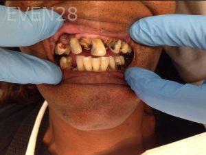 Ahmad-Aghakhan-Moheb-Dr-Sasha-Dentures-before-1