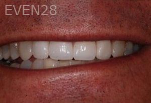 Albert-Sukut-Dental-Crowns-after-2