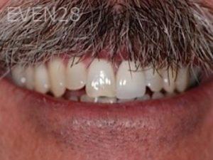 Albert-Sukut-Dental-Crowns-before-1