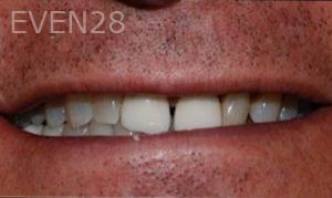 Albert-Sukut-Dental-Crowns-before-2