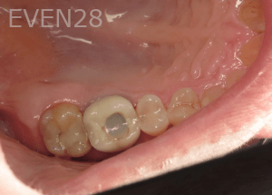 Ali-Sadri-Dental-Crowns-before-1