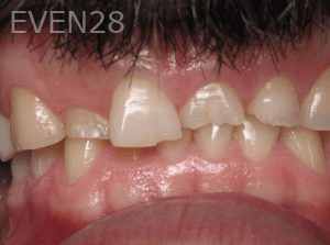 Ali-Sadri-Dental-Crowns-before-2