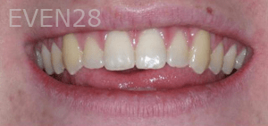 Ali-Sadri-Teeth-Whitening-Before-1