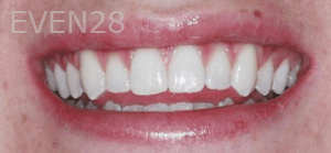 Ali-Sadri-Teeth-Whitening-after-1