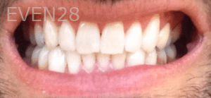 Ali-Sadri-Teeth-Whitening-after-2
