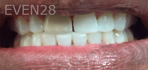 Ali-Sadri-Teeth-Whitening-after-4