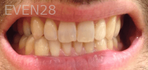 Ali-Sadri-Teeth-Whitening-before-2