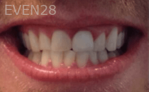 Ali-Sadri-Teeth-Whitening-before-3