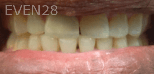 Ali-Sadri-Teeth-Whitening-before-4