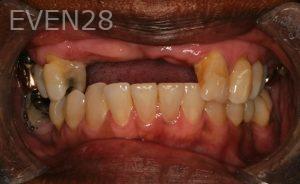 All-on-four-not-candidate-1