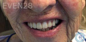 Andrew-Finley-All-on-Four-Dental-Implants-after-1