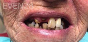 Andrew-Finley-All-on-Four-Dental-Implants-before-1