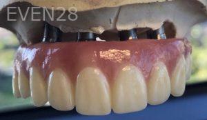 Andrew-Finley-All-on-Four-Dental-Implants-before-1b