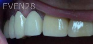 Andrew-Finley-Dental-Crowns-after-3