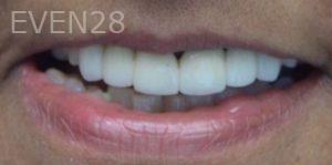 Andrew-Finley-Dental-Crowns-before-2