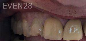 Andrew-Finley-Dental-Crowns-before-3