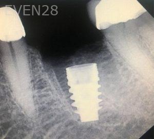 Andrew-Finley-Dental-Implants-after-1