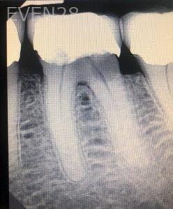 Andrew-Finley-Dental-Implants-before-