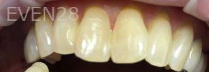 Andrew-Finley-Teeth-Whitening-before-1