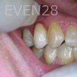 Anthony-Rassouli-Dental-Implants-after-1