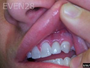 Anthony-Rassouli-Dental-Implants-after-2
