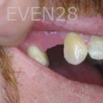 Anthony-Rassouli-Dental-Implants-before-1