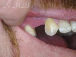 Anthony-Rassouli-Dental-Implants-before-1