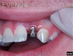 Anthony-Rassouli-Dental-Implants-before-2