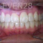 Anthony-Rassouli-Invisalign-Clear-Aligners-after-2