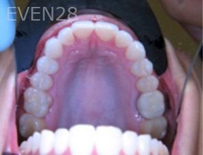 Anthony-Rassouli-Invisalign-Clear-Aligners-after-4