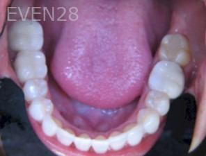 Anthony-Rassouli-Invisalign-Clear-Aligners-after-4b