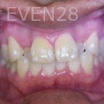 Anthony-Rassouli-Invisalign-Clear-Aligners-before-2