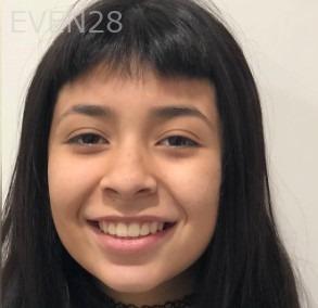 Arianna-Martinez-Orthodontic-Braces-after-1