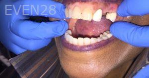 Armine-Nazarian-Partial-Dentures-before-1