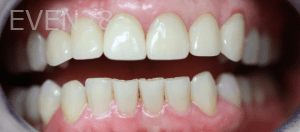 Christian-Song-Woo-Jung-Dental-Crowns-after-3
