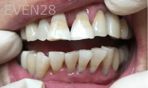 Christian-Song-Woo-Jung-Implant-Teeth-Whitening-after-2