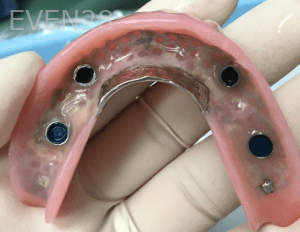 Christian-Song-Woo-Jung-Implant-supported-Overdentures-after-1