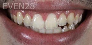 Christopher-Fotinos-Teeth-Whitening-after-1