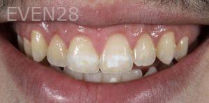 Christopher-Fotinos-Teeth-Whitening-before-1