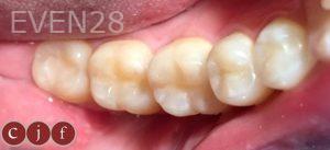 Christopher-Fotinos-White-Fillings-after-1