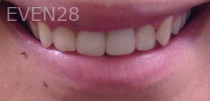 Dan-Benyamini-Dental-Crowns-after-2