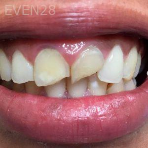 Dan-Benyamini-Dental-Crowns-before-1