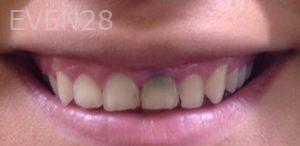 Dan-Benyamini-Dental-Crowns-before-2