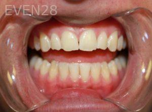 Dana-Nichols-Dental-Bonding-before-1