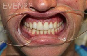 Dana-Nichols-Dental-Crowns-after-4