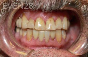 Dana-Nichols-Dental-Crowns-before-1