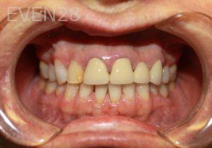 Dana-Nichols-Dental-Crowns-before-2